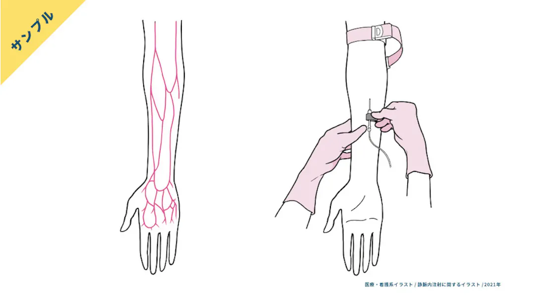 サンプル 静脈注射の手技 前腕の血管走行