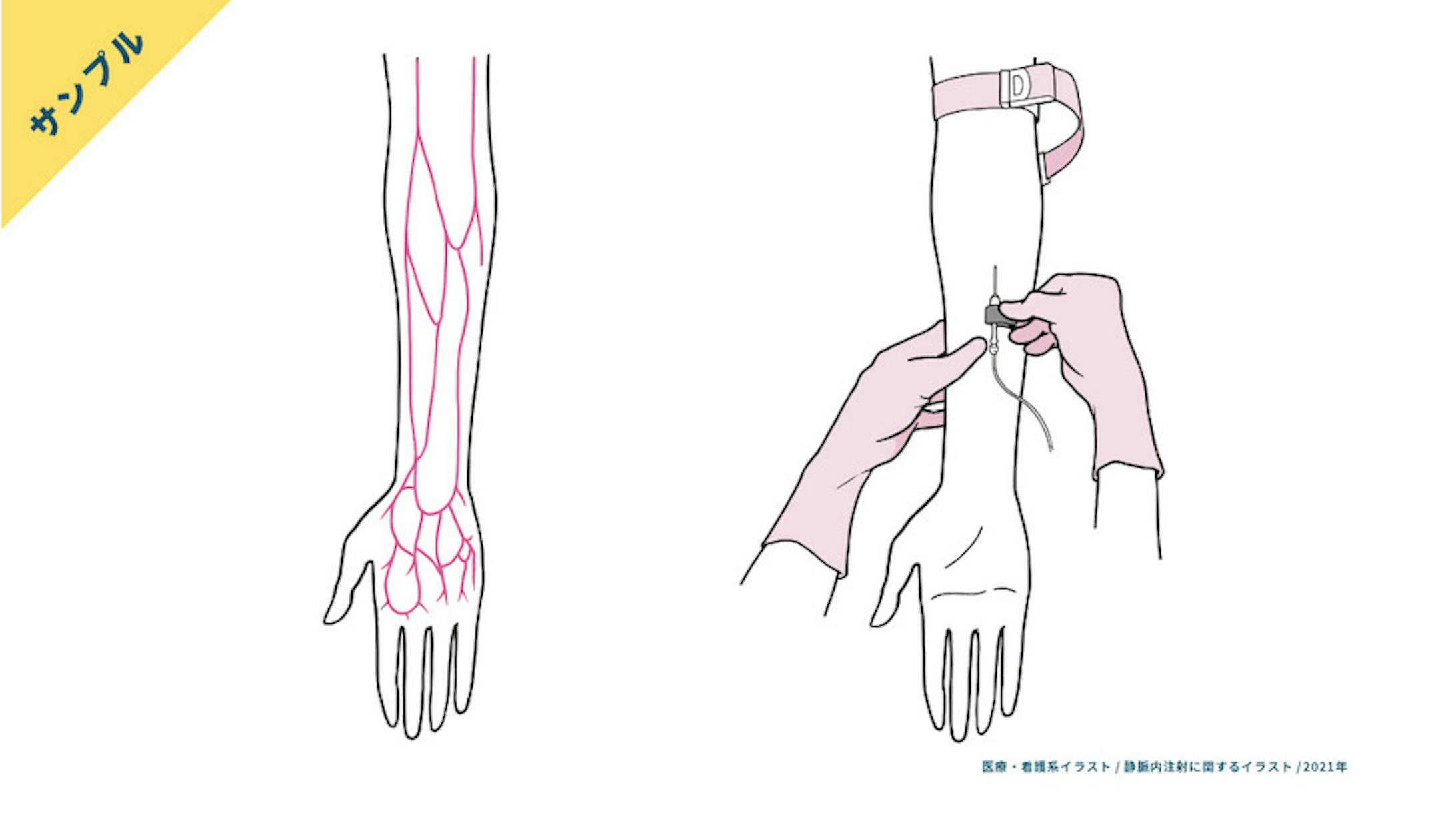 【サンプル】静脈注射の手技・前腕の血管走行-1