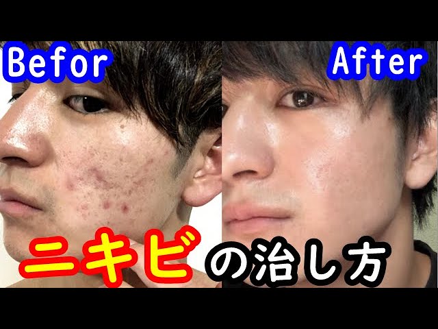 確実にニキビを治す方法をまとめました！