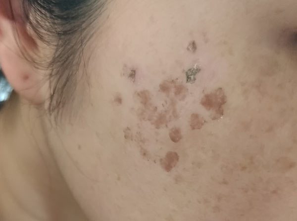 【2023年最新版】シミ取り放題キャンペーンが安いクリニック・皮膚科！おすすめ！シミ取りレーザーの値段比較