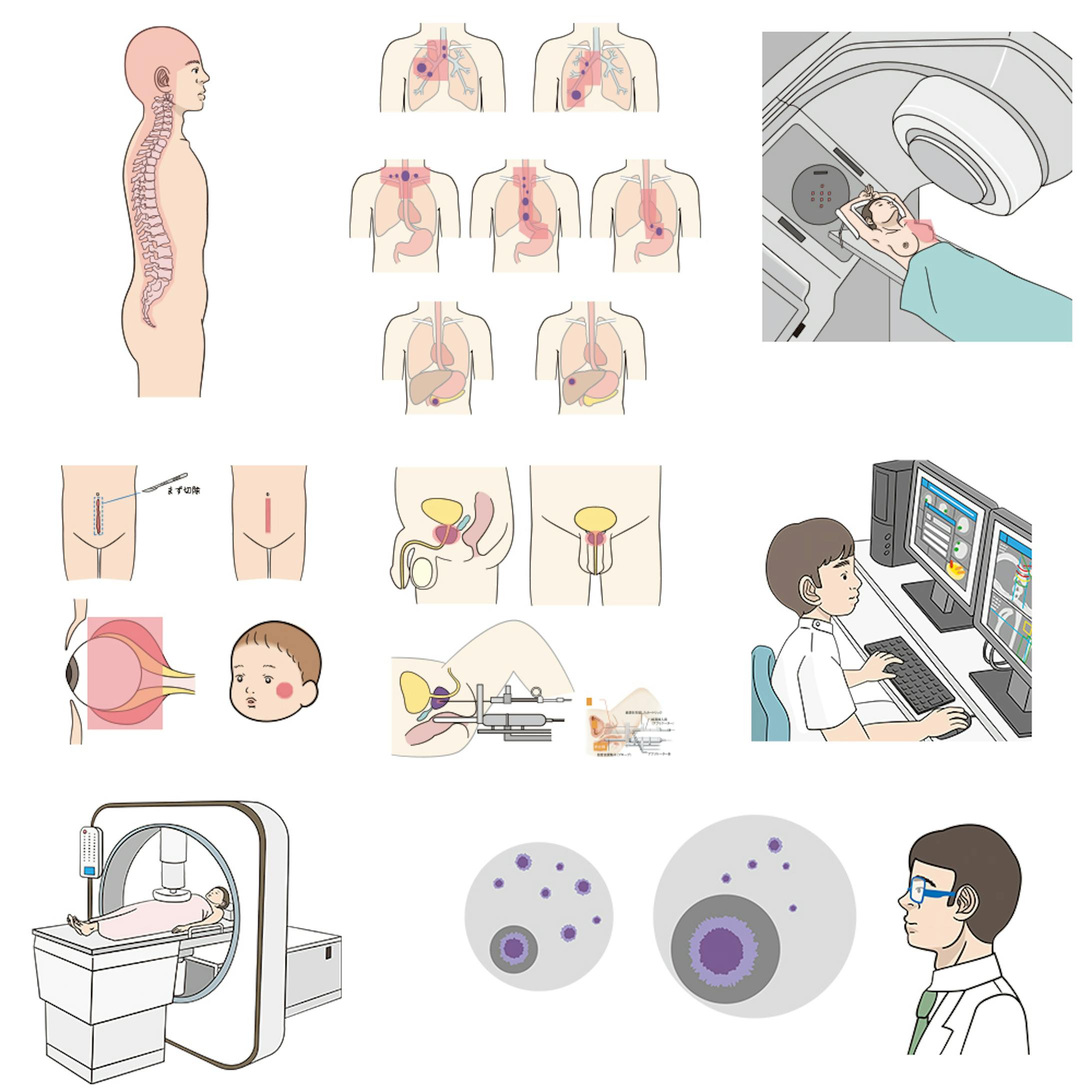 患者さんと家族のための放射線治療q 0年版 イラスト担当