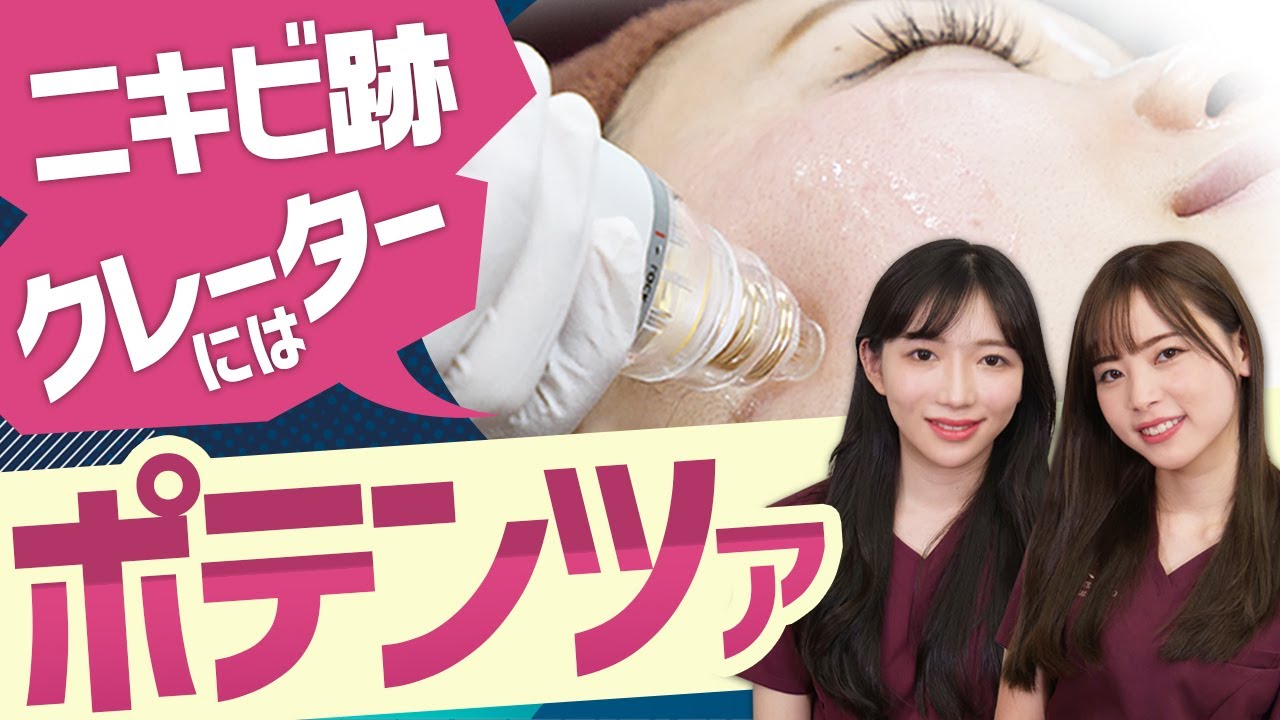 【ダーマペンの進化版！？】ニキビ跡やクレーター肌に、皮膚の負担や痛みが激減したニードル治療！【ポテンツァ（POTENZA）】