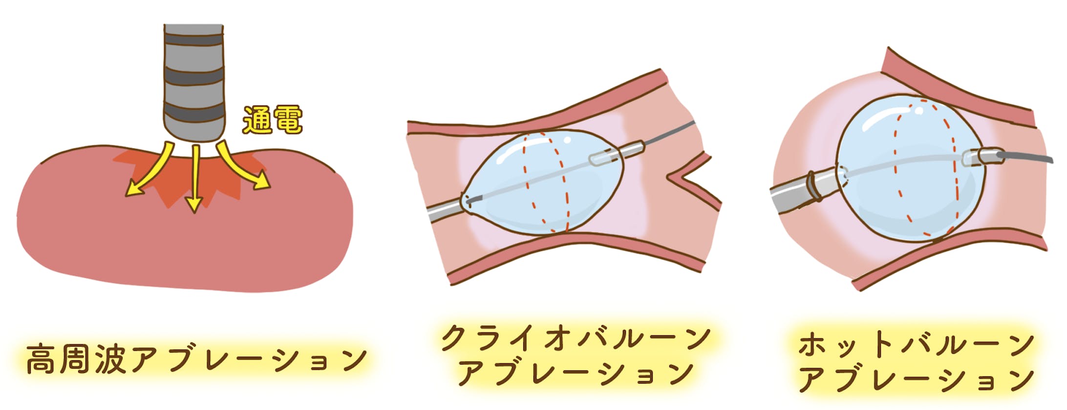 『カテーテル検査＆治療説明シート』イラスト担当-1