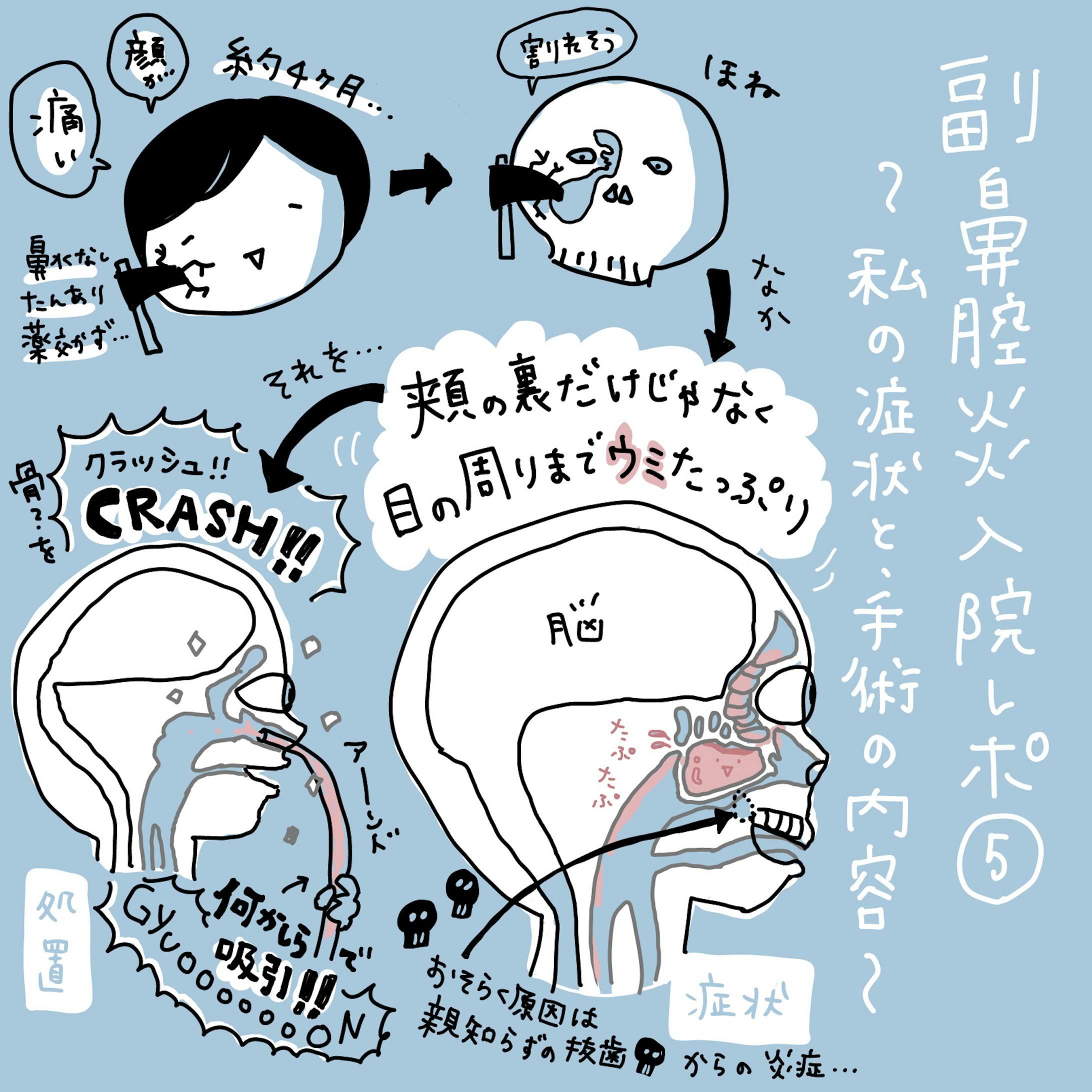 イラストレポ 副鼻腔炎入院レポ