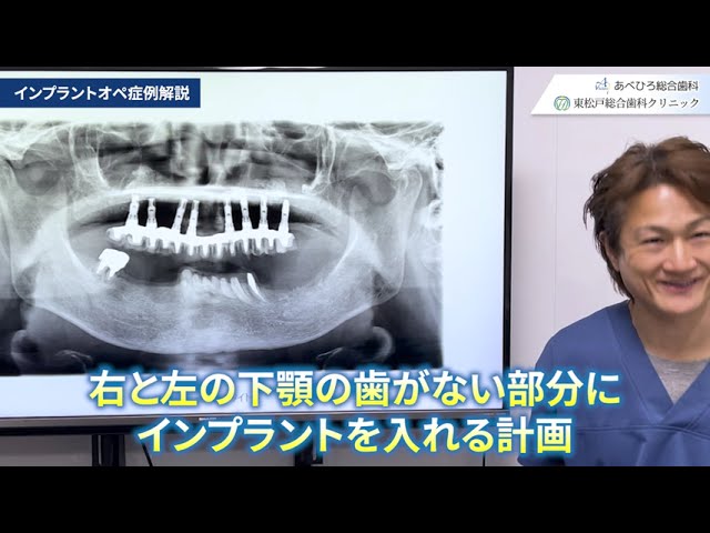 【あべひろ総合歯科】インプラントオペ症例解説